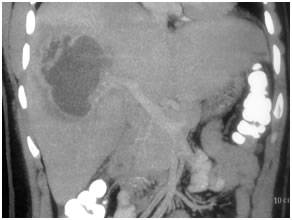 Amoebic Liver Abscess Amoebic Liver Abscess