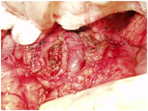 Beger's head coring (pancreatic neck is split exposing the vein) Beger's head coring