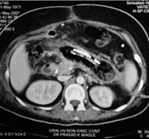 CT Scan of Infected Pancreatic necrosis CT Scan of Infected Pancreatic necrosis