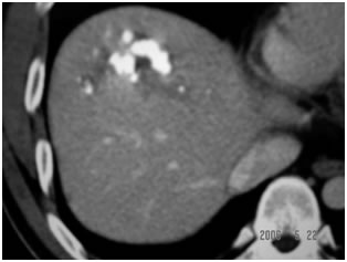 CT Scan showing Lipoidol uptake in segment VIII CT Scan showing Lipoidol uptake in segment VIII