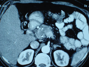 CT of pancreatic head mass showing stipled calcification CT of pancreatic head mass showing stipled calcification