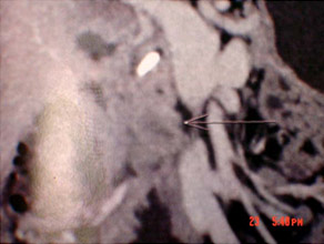 CT scan of Chronic pancreatitis with cancer CT scan of Chronic pancreatitis with cancer