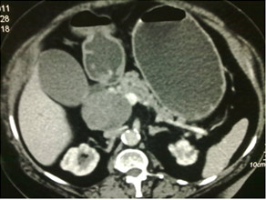 CT scan of Solid pseodopapillary tumor in pancreatic head CT scan of Solid pseodopapillary tumor in pancreatic head