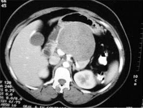 Solid pseudopapillary tumor in pancreatic body Solid pseudopapillary tumor in
pancreatic body
