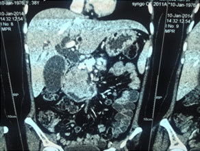 >CT scan of chronic pancreatitis with large tumor, stones in the pancreatic duct >CT scan of chronic pancreatitis with large tumor, stones in the pancreatic duct