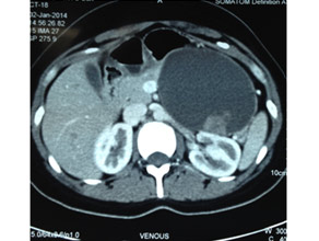 CT scan of large mucinous cystic tumor with a solid component in pancreatic body CT scan of large mucinous cystic tumor with a solid component in pancreatic body
