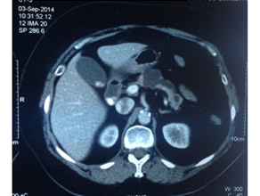 CT scan of main duct Intraductal Papillary Mucinous Neoplasm (IPMN) CT scan of main duct Intraductal Papillary Mucinous Neoplasm (IPMN)