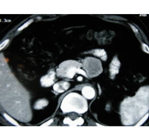 CT scan of pancreatic cancer in the body CT scan of pancreatic cancer in the body