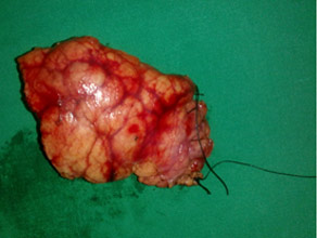 Central pancreatectomy specimen of Main duct IPMN Central pancreatectomy specimen of Main duct IPMN