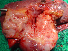 Chronic pancreatitis with cancer Chronic pancreatitis with cancer