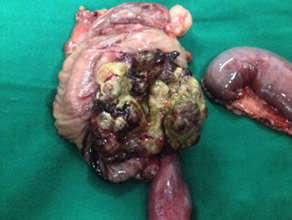 Chronic pancreatitis with fungating tumor (specimen) Chronic pancreatitis with fungating tumor (specimen)