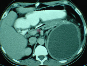 Chronic pancreatitis with large pseudocyst Chronic pancreatitis with large pseudocyst