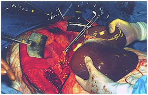 Deceased Donor Liver transplant Deceased Donor Liver transplant