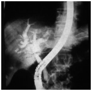 ERCP showing type I hilar block ERCP showing type I hilar block