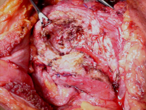 Freys head coring for a large pancreatic head mass Freys head coring for a large pancreatic head mass