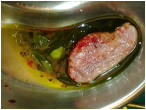 Gallbladder containing daughter cyst Gallbladder containing daughter cyst