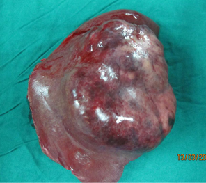 HCC in a non cirrhotic liver HCC in a non cirrhotic liver