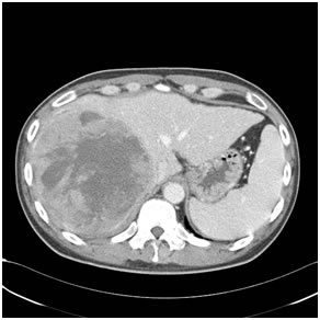 Hepatobiliary Disorders Requiring Surgery Hepatobiliary Disorders Requiring Surgery