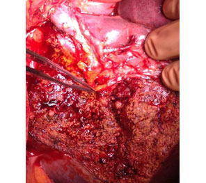Hilar CC after resection Hilar CC after resection