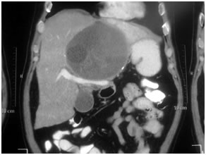 Hydatic Cyst in Liver Hydatic Cyst in Liver