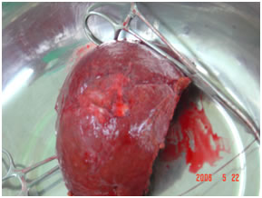 Specimen Showing Desected Gallbladder cancer Specimen Showing Desected Gallbladder cancer