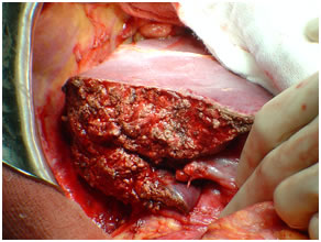 Removal of Cancer Gall bladder Removal of Cancer Gallbladder