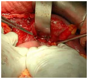 Intra Operative picture of Hepatico Jejunostomy Intra Operative picture of Hepatico Jejunostomy