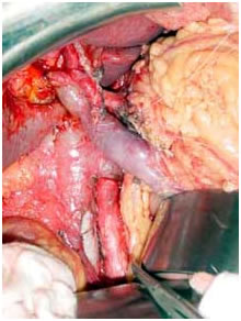 Intra operative photo after radical resection Intra operative photo after radical resection