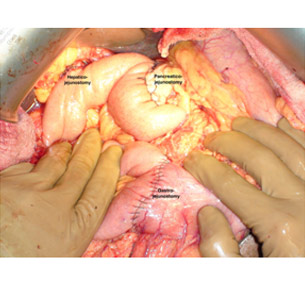 Intraoperative photo showing all the anastomosis Intraoperative photo showing all the anastomosis