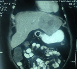 Large HCC in seg 2&3 Large HCC in seg 2&3