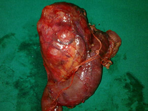 Large solid pseudopapillary tumor in pancreatic head LLarge solid pseudopapillary tumor in pancreatic head