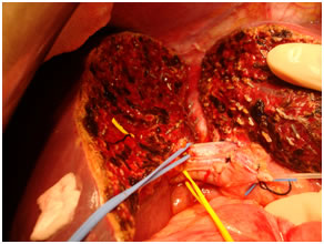 Living Donor Hepatectomy Living Donor Hepatectomy