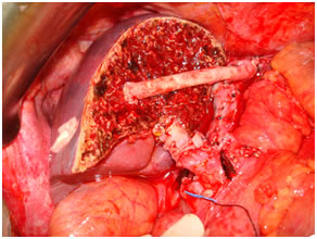 Living donor Liver transplantation Living donor Liver transplantation