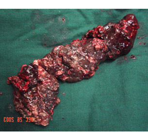 Necrotising pancreatitis Cast Necrotising pancreatitis Cast
