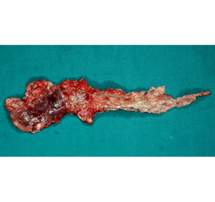 Necrotising pancreatitis specimen(infected) Necrotising pancreatitis specimen(infected)