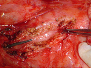 Opened pancreatic duct with stent inserted proximal to the stricture (forceps) Opened pancreatic duct with stent inserted proximal to the stricture (forceps)
