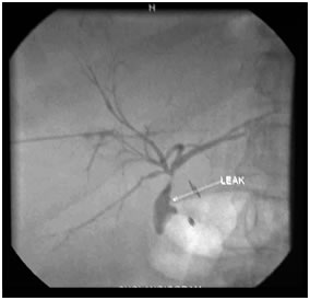 PTBD gram showing biliiary leak PTBD gram showing biliiary leak