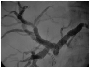 PTBD gram showing type II biliary stricture PTBD gram showing type II biliary stricture