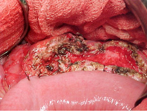 Pancreatico-jejunostomy: a standard procedure Pancreatico-jejunostomy: a standard procedure