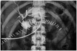 Post operative PTBD gram showing a patent high hepaticojejunostomy Post operative PTBD gram showing a patent high hepaticojejunostomy