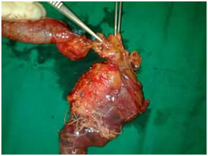 Resected specimen after Whipple's procedure Resected specimen after
Whipple's procedure