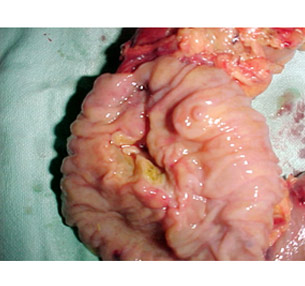 Resected specimen showing ampullary cancer Resected specimen showing ampullary cancer