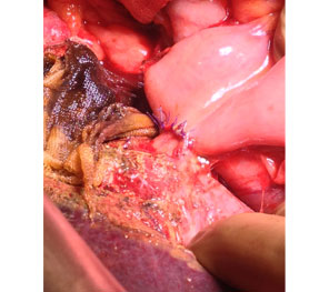 Rt Hepatico-jejunostomy Rt Hepatico-jejunostomy