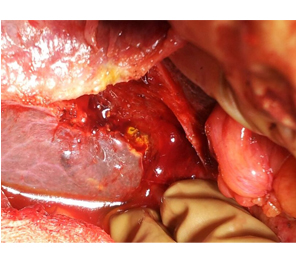 Separate R & L ducts Separate R & L ducts
