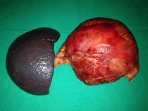 Specimen of Large cystic tumor in pancreatic body Specimen of Large cystic tumor in pancreatic body