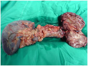 Specimen of Solid pseudopapillary tumor in pancreatic body Specimen of Solid pseudopapillary tumor in pancreatic body