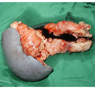 Specimen of distal pancreatectomy spleenectomy for cancer Specimen of distal pancreatectomy spleenectomy for cancer