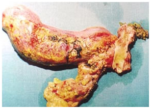 Specimen of radical bile duct excision Specimen of radical bile duct excision