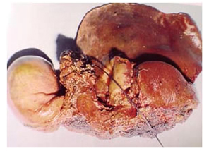 Specimen of resected hilarcholangiocarcinoma Specimen of resected hilarcholangiocarcinoma