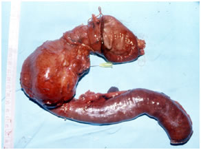 Specimen photo after radical resection for pancreatic cancer Specimen photo after radical resection for pancreatic cancer